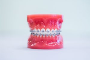 Metal Braces | Lifetime Orthodontics | Grosse Pointe Woods