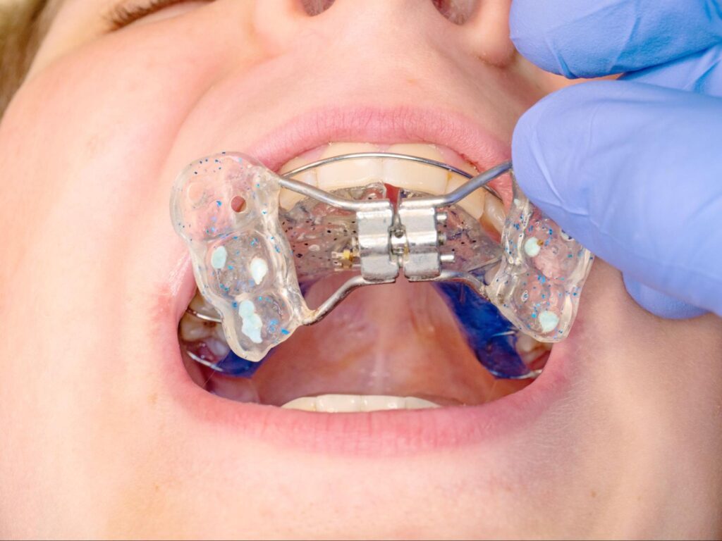What Are Interceptive Orthodontics?